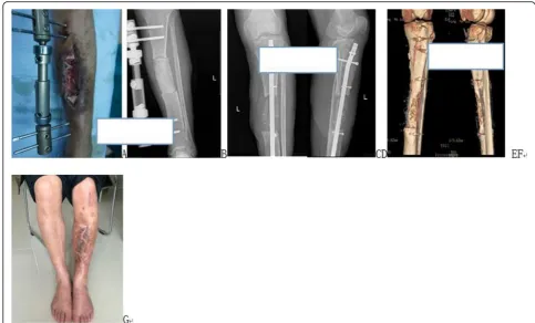 Fig. 3 A patient with an infective left tibial bone defects who was treated with induced membrane cancellous bone graft.appearance