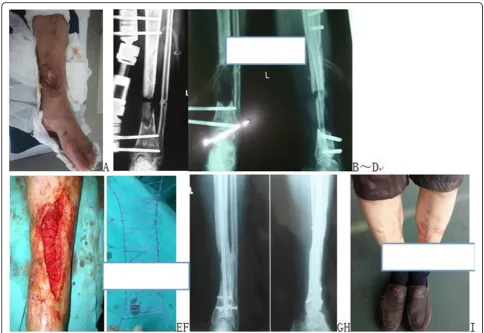 Fig. 4 A patient with infected left tibial bone defects treated with line mesh wrapped cancellous bone graft in second intention surgery
