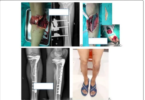 Table 2 Therapeutic outcome of four cancellous bone wrapping grafting techniques