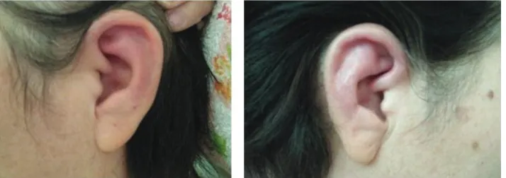 Figure 2: Histological findings of biopsy specimen from the left ear. Perichondritis with the mononuclear cells and polymorphonuclear ×show perichondritis with the presence of mononuclear cells and polymorphonuclear leukocytes at the fibrochondral junction
