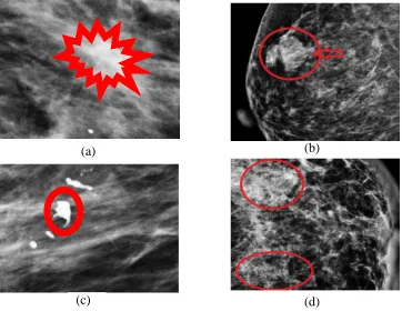 Fig. 5 Examples of mammogram images, (a) Mass (High density mass), (b) Distortion (Having distortion), (c) Calcification (Macrocalcification), and (d) Calcification (Clustered microcalcification)