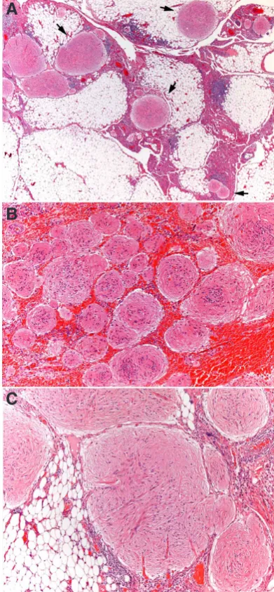 Fig. 1. Characteristic appearance of Gliomatosis peritonei (GP) at low power. Multiple astrocytic nodules (arrows) are scattered throughout the omental surface and underlying fatty tissue (A)