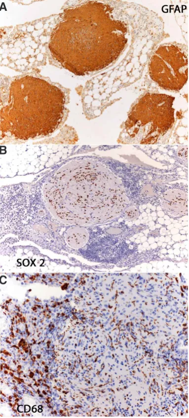 Fig. 2. Immunohistochemistry of Gliomatosis peritonei (GP). Nodules are intensely positive for glial fibrillary acidic protein (A)