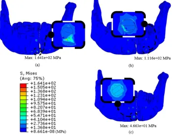 Fig. 3  Pressure occur in screw hole on bone surface by (a) MF-42, (b) MF-44, and (c) MF-24 configuration  