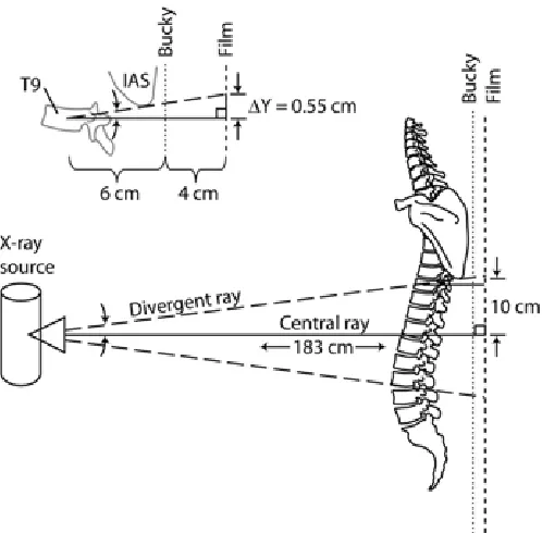 Figure 3Because of radiographic image distortion, the actual vertebral level corresponding to the IAS is approximately one-half cm lower than reported herein