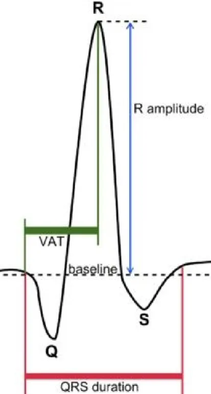 Figure 3.2: Schematic representation of the QRS complex
