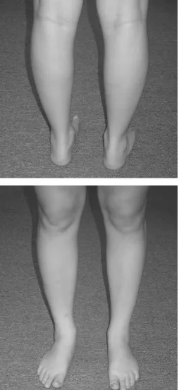 Figure 1Standing postural evaluation demonstrating bilateral pes planus with mild calcaneal eversion.