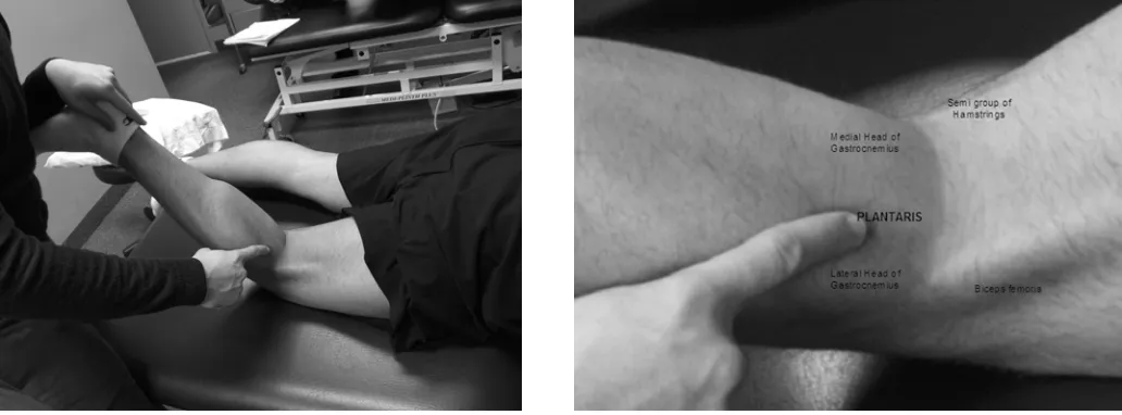 Figure 2a) Technique for palpation of the plantaris muscle. With the patient prone and the leg flexed to approximately 90 degrees, your distal hand covers the heel while your forearm is applied against the plantar aspect of the foot, allowing a simultaneou