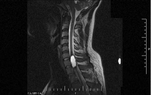 Figure 1Expansive intramedullary lesion with peripheral enhancement and extending from C6 to T1