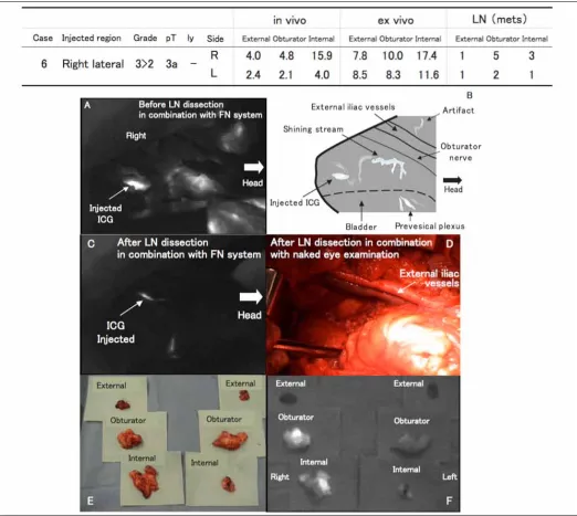 Fig. 1. Lymph node (LN) mapping in a bladder cancer patient without LN metastases identified by the fluorescence navigation system (Case #6, right side); A: fluorescent lymphatic flow in the internal iliac region after direct injection of indocyanine green
