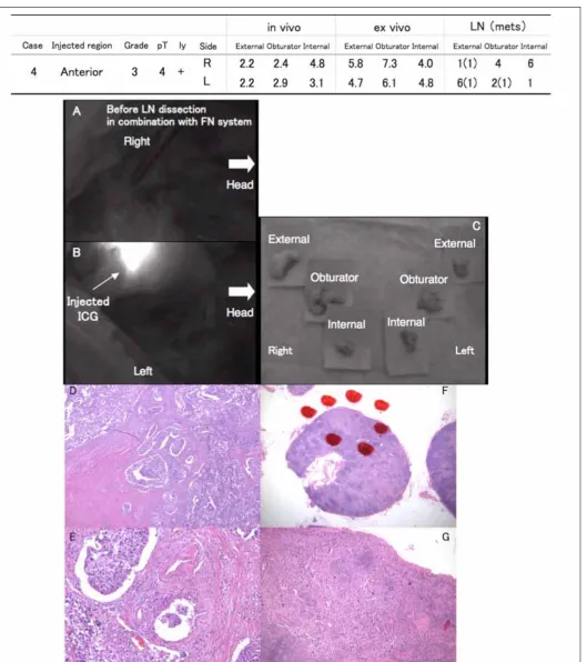 Fig. 2. Pathological lymph node (LN) involvement in relation to the lymphatic pathway identified by the fluorescence navigation (FN) system (Case #4); A, B, C: Although pathological examination showed metastasis in the bilateral external iliac and left obturator LNs, there was no strong fluorescence in the regional LNs of the bladder either in vivo or ex vivo; D, E: Pathological examination revealed that urothelial carcinoma (grade 3) had diffusely invaded lymphatic vessels in the bladder; F, G: Urothelial carcinoma infiltrated the bilateral external and left obturator LNs.