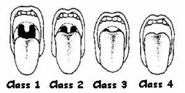 Fig. 3.1 – Mallampati classification of the airway 
