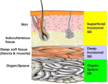 Figure 6.1 – Cross-section of abdomen depicting classification of surgical site  infection according to the Centers for Disease Control and Prevention (United  States) 
