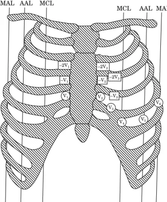 Figure 1 The standard precordial positions of conven- conven-tional chest leads V 1 to V 6 (open circles) and the higher intercostal space ECG leads: V 1 to V 3 and 2V 1 to