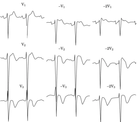 Figure 2 The initial standard ECG leads V 1 to V 3 of a near sudden unexplained death syndrome (NSUDS) showed no typical right bundle branch block or ST elevation typical of the Brugada syndrome (Brugada sign) but when the new higher intercostal space ECG 
