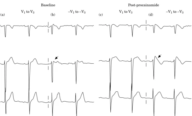 Figure 3 The pre- and post-procainamide ECGs of a relative of a near sudden unexplained death syndrome patient
