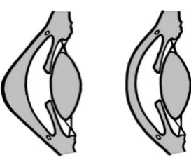 Figure 1.Normal cornea (right) and cornea with keratoconus (left)