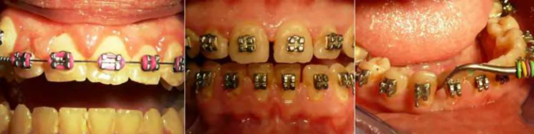 Fig. 8. Periodontal alteration present during orthodontic treatment. 