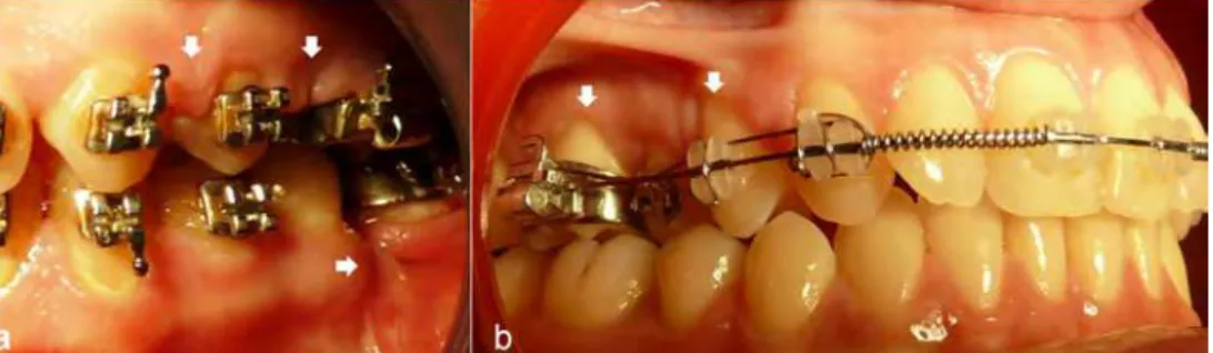 Fig. 9. Periodontal complications - gingival enlargement, interdental fold - present during  orthodontic therapy (a); Gingival recessions associated with crossbite malocclusion, not  linked to the orthodontic appliance’s presence (b)