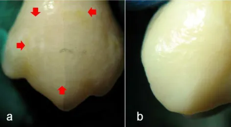 Fig. 1. Microscopic aspect of the enamel surface of a maxillary first premolar with a history  of orthodontic treatment – buccal enamel surface (a); lingual enamel surface (b) 