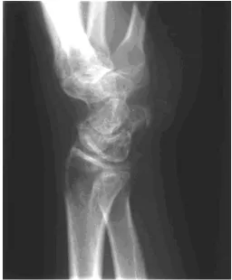 Figure 2Multiple lucencies in the right carpal bones.