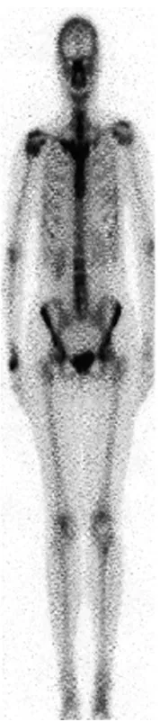 Figure 4Full-body scan with increase uptake in the right upper limb and SC joint.