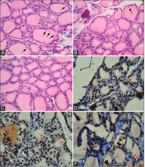 Fig. 3: A-C represent photomicrographs of thyroid section of experimental rats H and E (×400) and D-F represent immunohistochemical with cappase-3 staining (×1000)