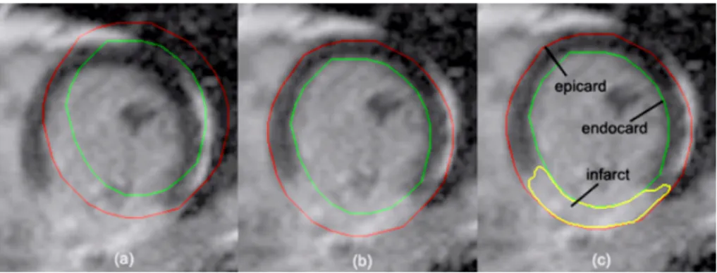 Figure 1: Visualization of the results of direct contour overlay (Cine-MR myocardial contours on DE-MR image data) before (a), and after (b) registration