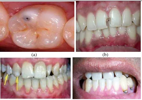 Fig. 1  Types of caries: (a) occlusal caries, (b) interproximal caries, (c) enamel caries,  (d) root caries  