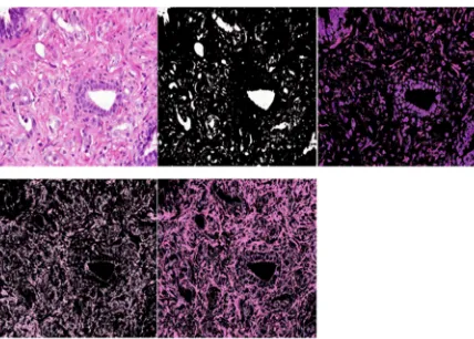 Fig. 4 A) Prostate Grade3 H&E histological image, B) The lumen tissue component, C) Nuclei tissue component