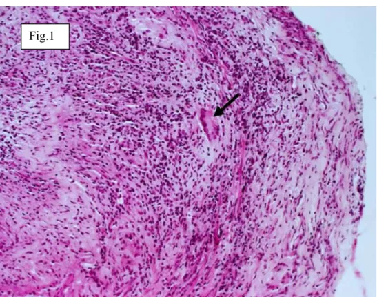 Fig. 1. GCA – biopsy of the wall of the superficial temporal artery (typical multinuclear large  cell) (from collection of prof