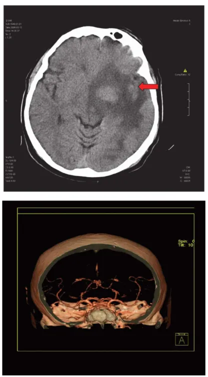 Fig. 2. CT and agio CT of the brain with lesion on left hemisphere, and typical segmental  arterial stenosis  in PACNS (owne case) 