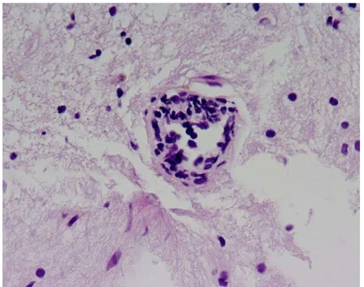 Fig. 3. Brain stereotactic biopsy from lesion in PACNS (lymphocytic cellular infiltrates of  vessel wall) (own case) 