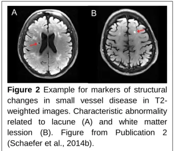 Figure  2  Example  for  markers  of  structural  changes  in  small  vessel  disease  in   T2-weighted images