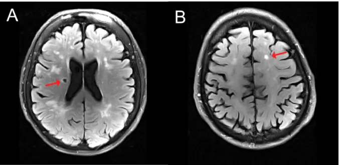 Figure  S1  FLAIR  image  with  examples  for  markers  of  structural  changes  in  small  vessel  disease