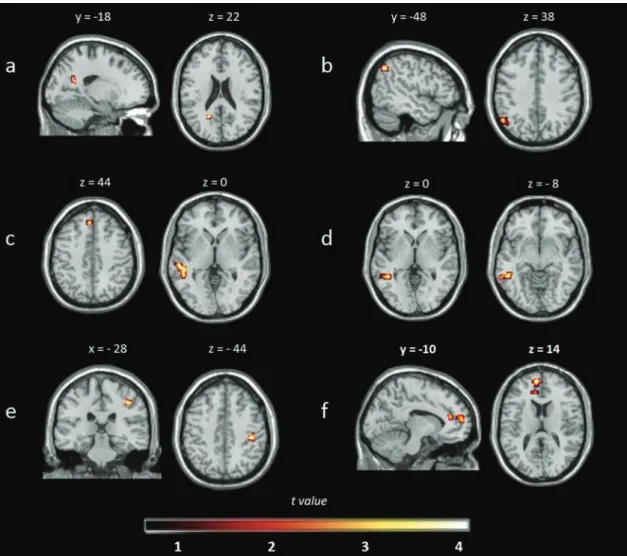 Figure 1.  (a) Default mode network (DMN): decreased resting-state functional connectivity (rs-FC) in cognitively impaired (CI)  patients compared with healthy controls (HCs); (b) DMN: decreased rs-FC in CI compared with cognitively preserved (CP) patients