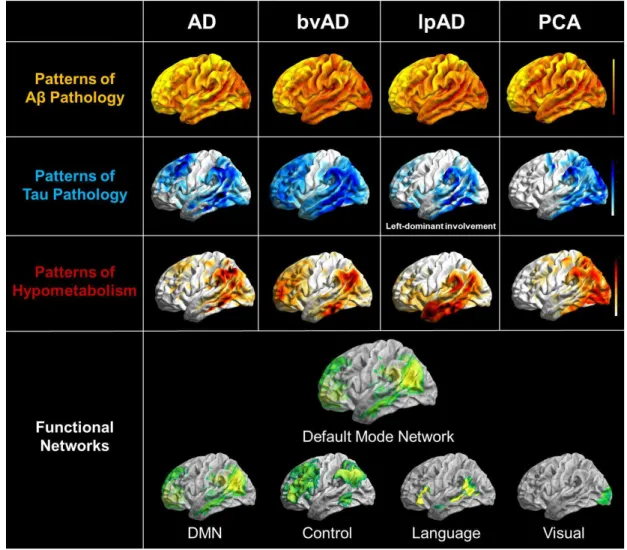 Figure  6  – Pathophysiological topographies and their overlap with functional connectivity networks in the  clinical  phenotypes  of  Alzheimer’s  disease