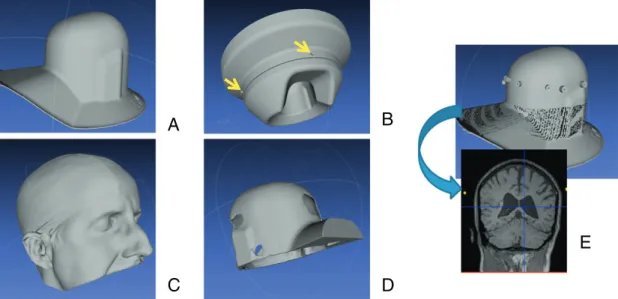 Fig. 1 shows the major components in the process of construction of the head cast. We used a manufacturer supplied dewar-helmet (A)