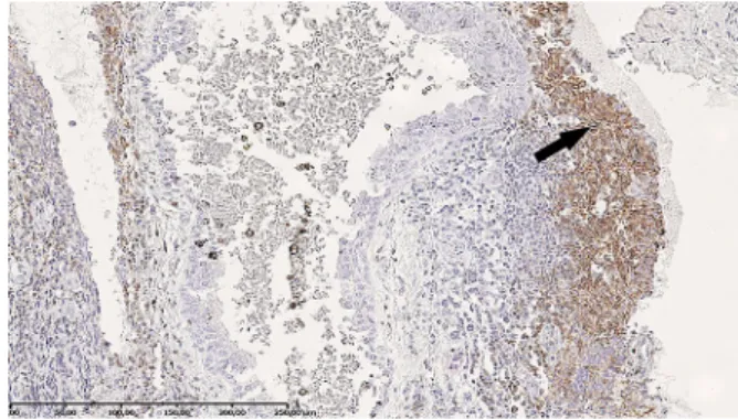 Fig. 4 CD3 expression in mononuclear cells (arrow: T lymphocytes) within the inﬂammatory inﬁltration; 9 200