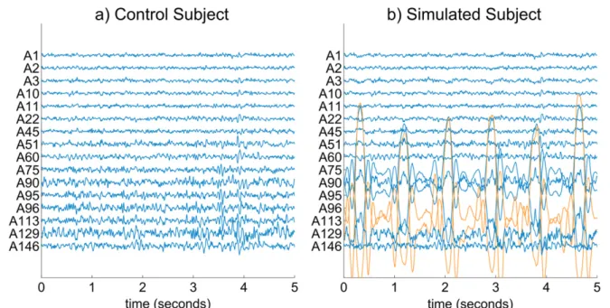 Figure 4. MEG channels (16 distributed evenly on the scalp) for: (a) control subject, that is, clean recording, free of metallic artifacts; (b) simulated subject