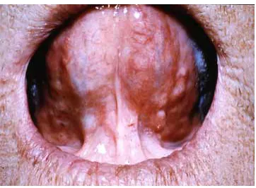 Figure 1T2 squamous cell carcinoma on the 