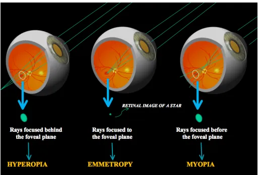 Figure 1. Eye vision of a point source (a star for instance).