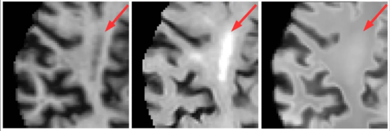 Fig. 9. An example where periventricular WMH has been synthesised. Left: Normalised T 1 -w image