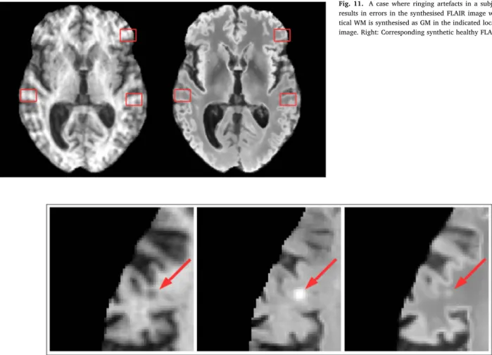 Fig. 12. A case where a lesion close to the cortex is mistakenly synthesised as hyper-intense