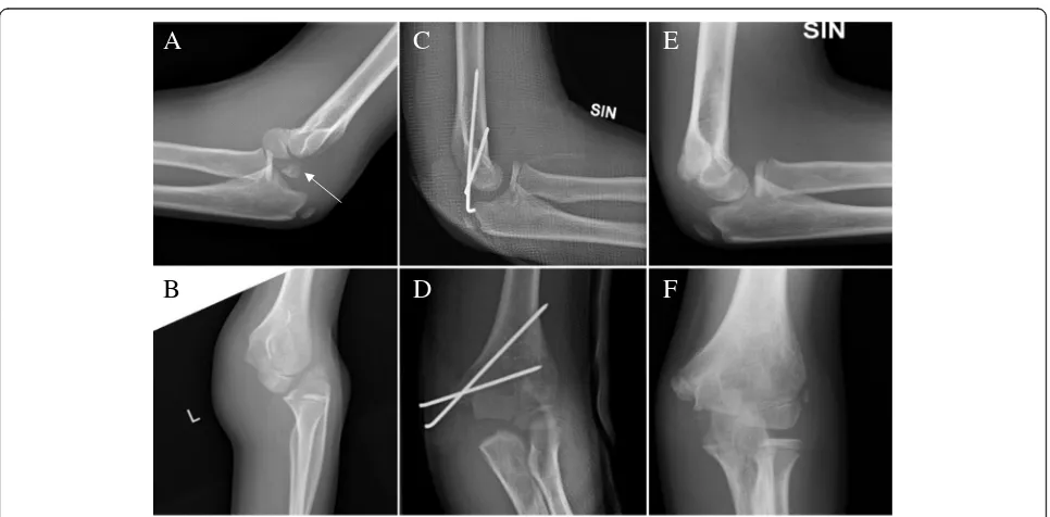 Fig. 1 A Boy, 10.8 years old, was injured during trampoline jumping. Lateral (follow-up visit the medial epicondyle was in good reduction