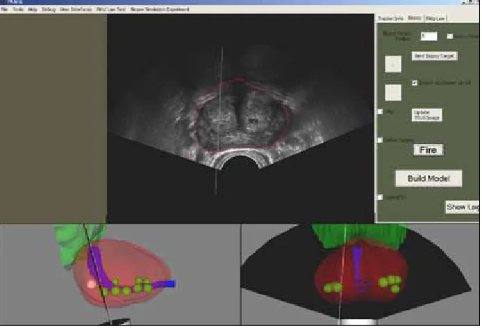 Fig. 5. 3D view showing biopsy control screen (axial view in upper panel; 3D sagittal view bottom left panel; 3D axial view bottom right panel)