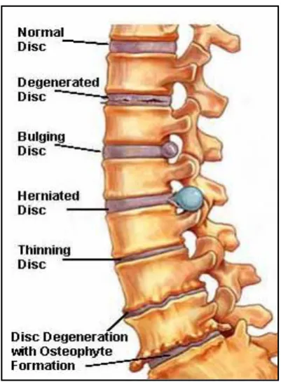 Figure 2.6 A.The normal intervertebral disc B. Degenerate lumbar 