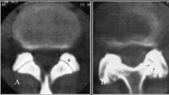 Figure 2.8 A. Normal facet  B. Notice reduction of the joint space. Adapted from www.nsmec.com