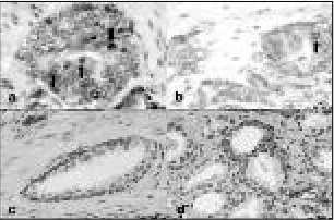 Fig. 1. P5. Fasting serum folate concentrations (nM) in patients with prostatecancer vs