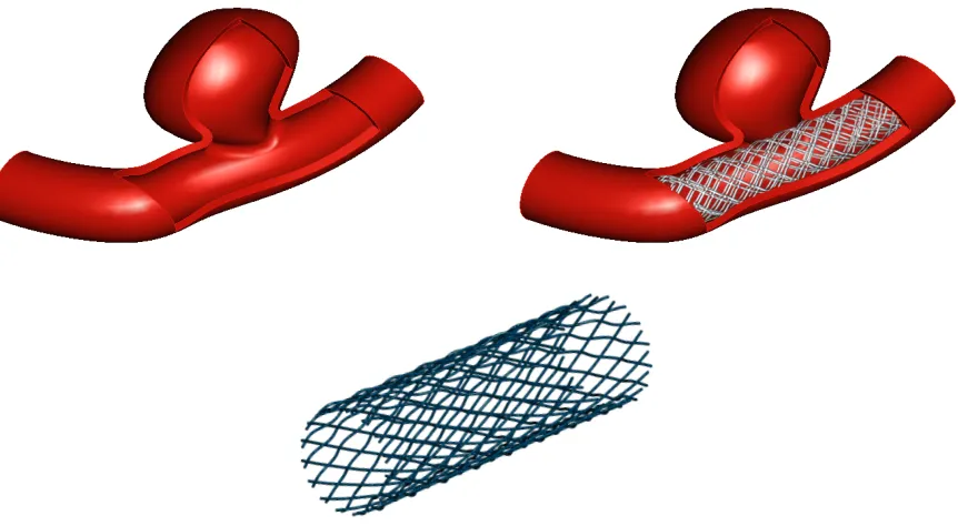 Figure 5. CAD model of a parent vessel with a side wall aneurysm (top left). Schematicillustration of a wire multi-layer stent, which reduces blood ﬂow into the aneurysm (top right).The cutout is for visualization purpose only
